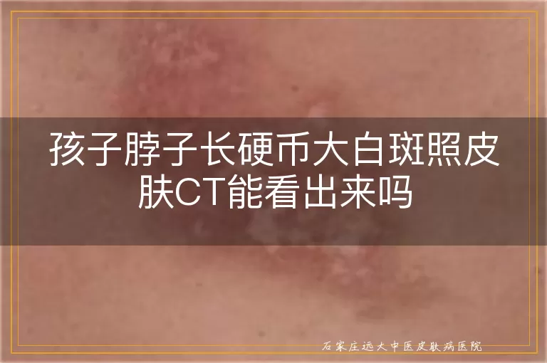 孩子脖子长硬币大白斑照皮肤CT能看出来吗