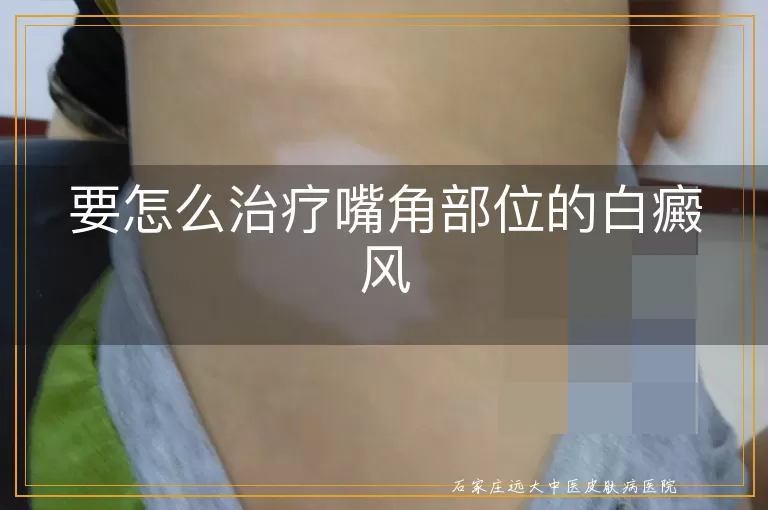 要怎么治疗嘴角部位的白癜风