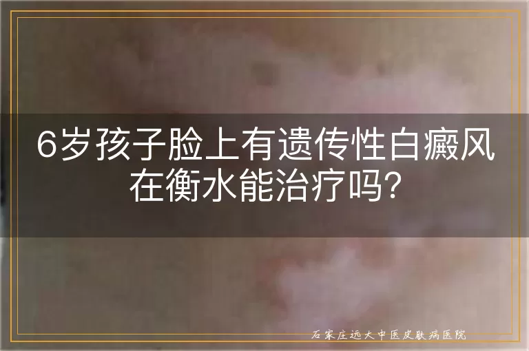 6岁孩子脸上有遗传性白癜风在衡水能治疗吗？