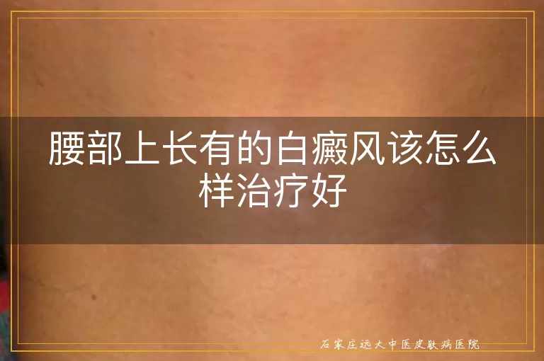 腰部上长有的白癜风该怎么样治疗好