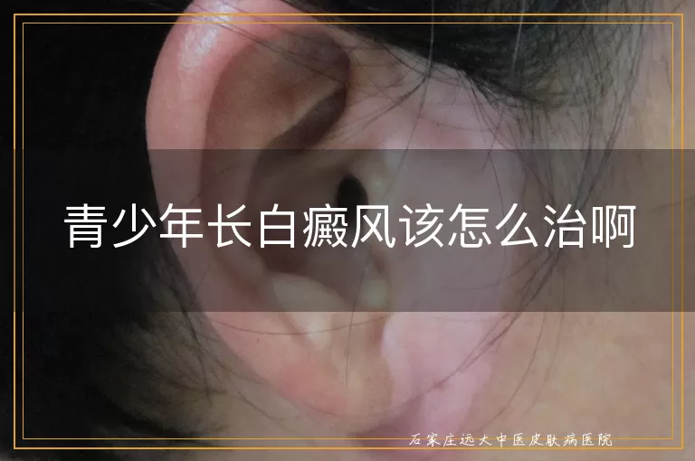 青少年长白癜风该怎么治啊