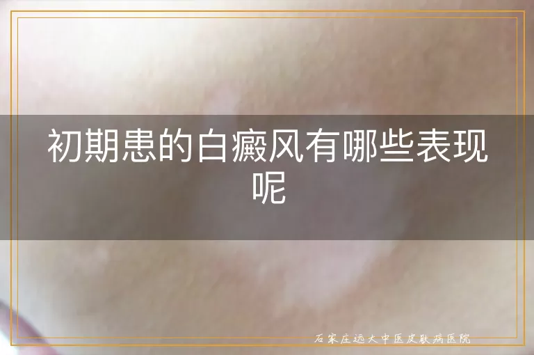 初期患的白癜风有哪些表现呢