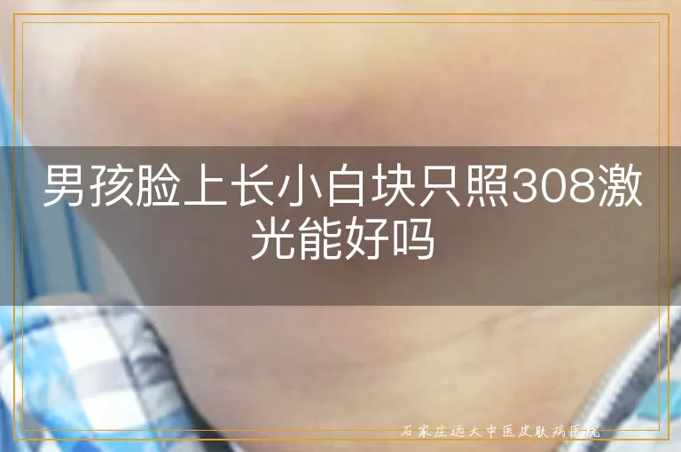 男孩脸上长小白块只照308激光能好吗