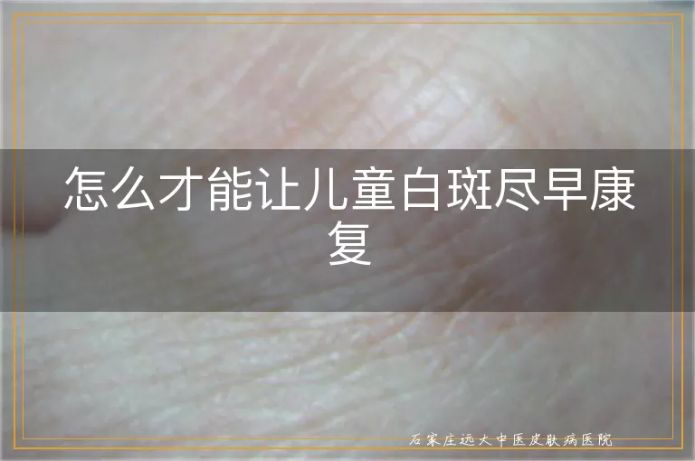 怎么才能让儿童白斑尽早康复