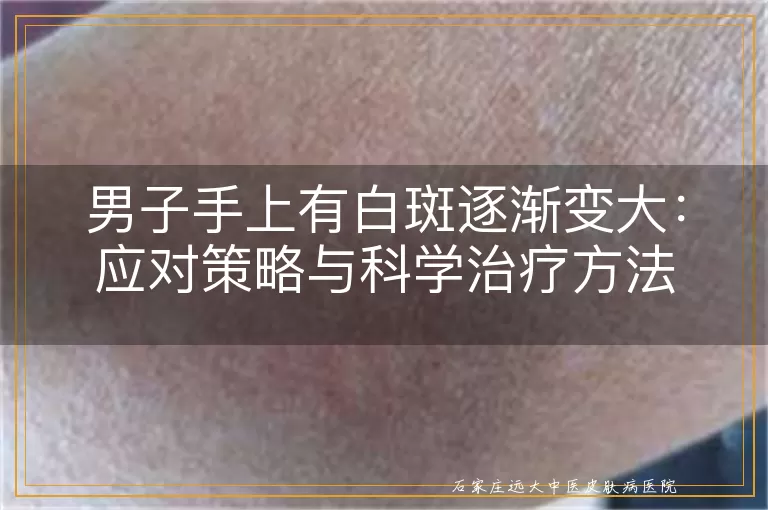 男子手上有白斑逐渐变大：应对策略与科学治疗方法