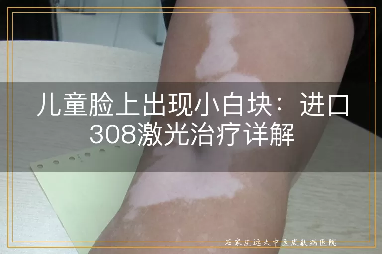 儿童脸上出现小白块：进口308激光治疗详解