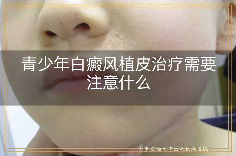 青少年白癜风植皮治疗需要注意什么