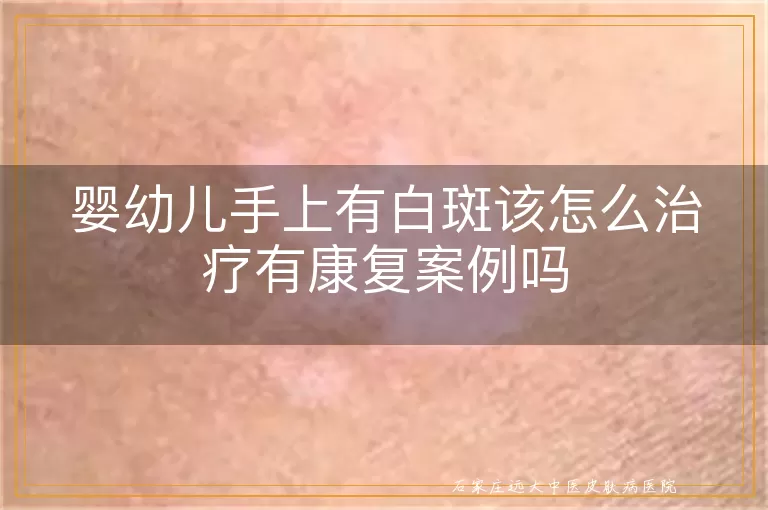 婴幼儿手上有白斑该怎么治疗有康复案例吗