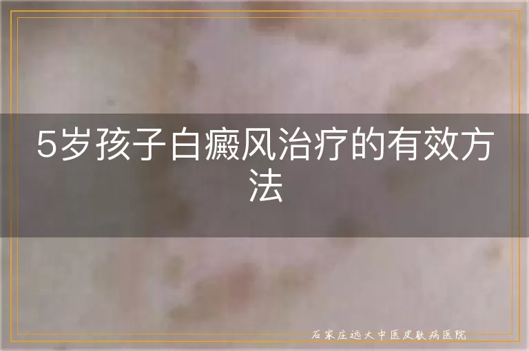5岁孩子白癜风治疗的有效方法