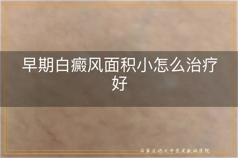 早期白癜风面积小怎么治疗好