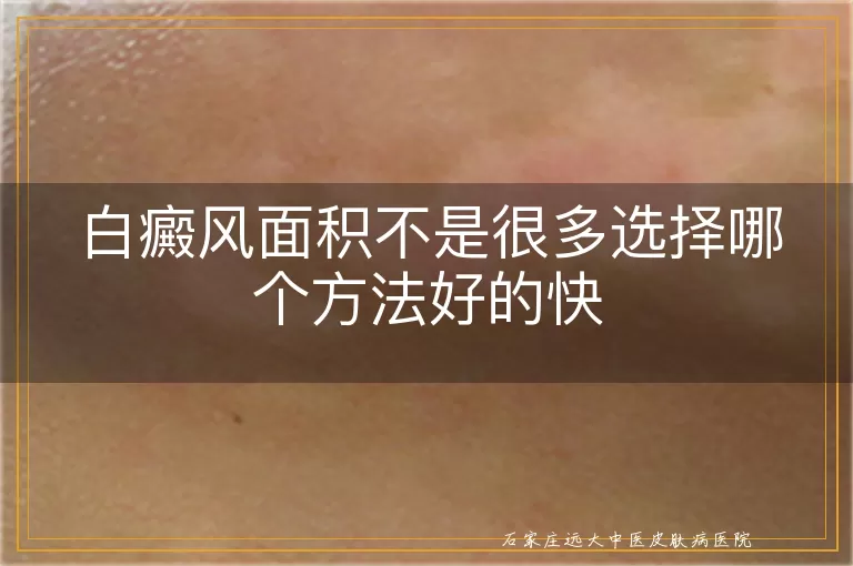 白癜风面积不是很多选择哪个方法好的快