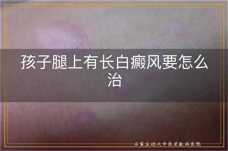 孩子腿上有长白癜风要怎么治