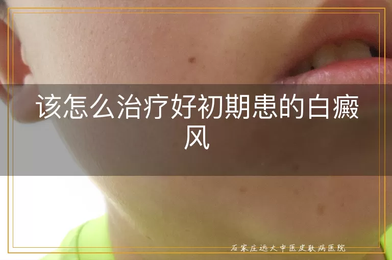 该怎么治疗好初期患的白癜风