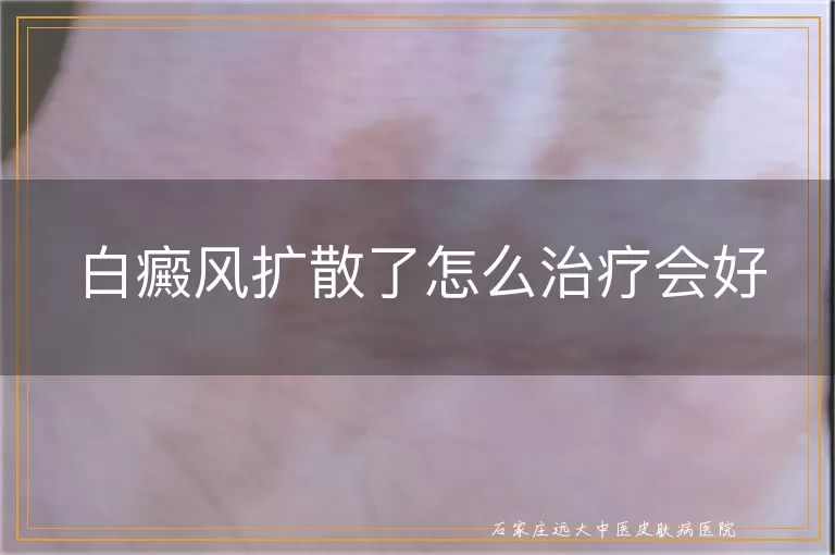 白癜风扩散了怎么治疗会好