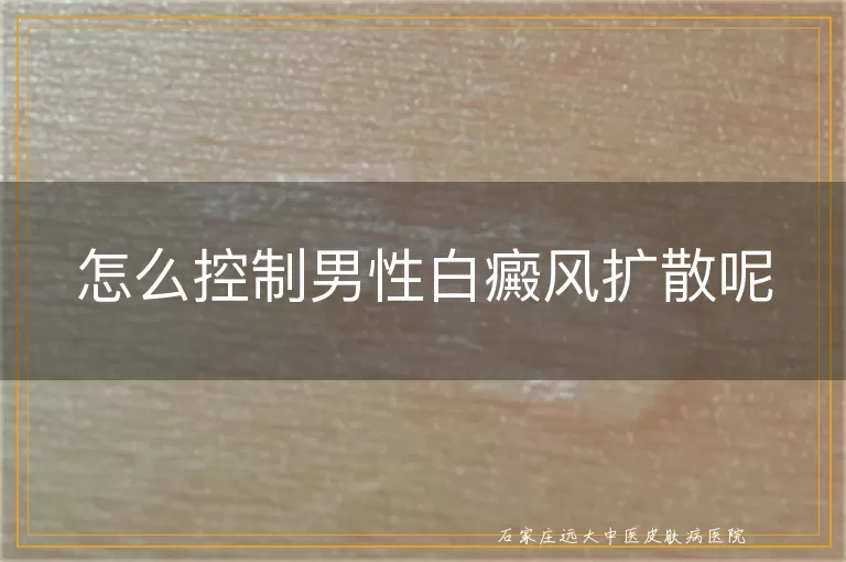 怎么控制男性白癜风扩散呢