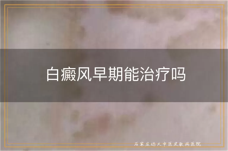 白癜风早期能治疗吗