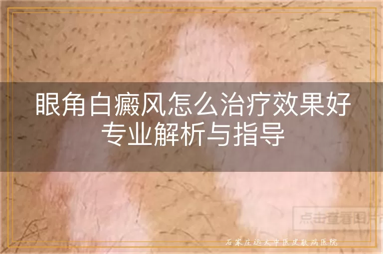 眼角白癜风怎么治疗效果好专业解析与指导