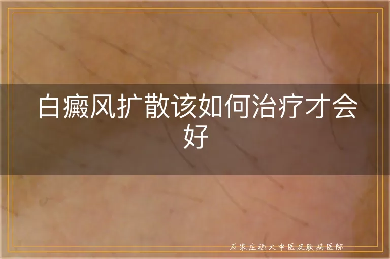 白癜风扩散该如何治疗才会好