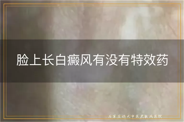 脸上长白癜风有没有特效药