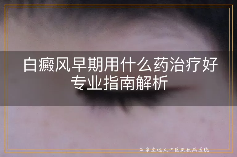 白癜风早期用什么药治疗好专业指南解析