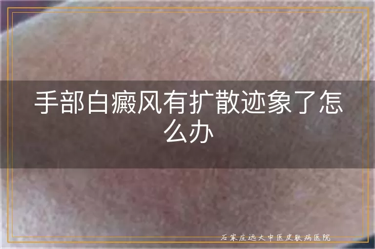 手部白癜风有扩散迹象了怎么办