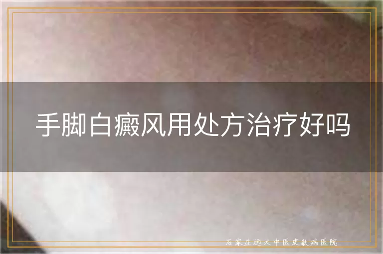 手脚白癜风用处方治疗好吗