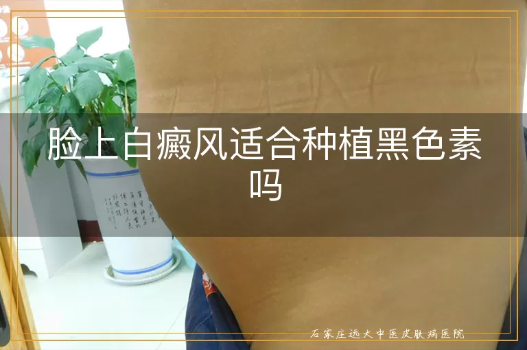 脸上白癜风适合种植黑色素吗