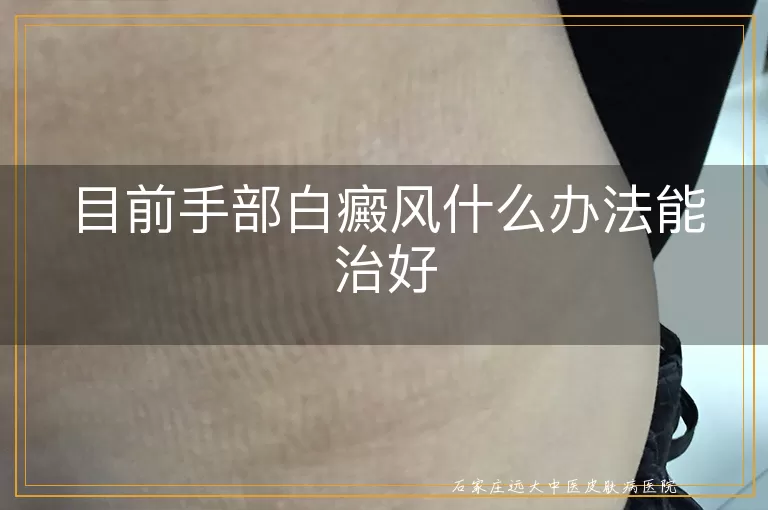 目前手部白癜风什么办法能治好