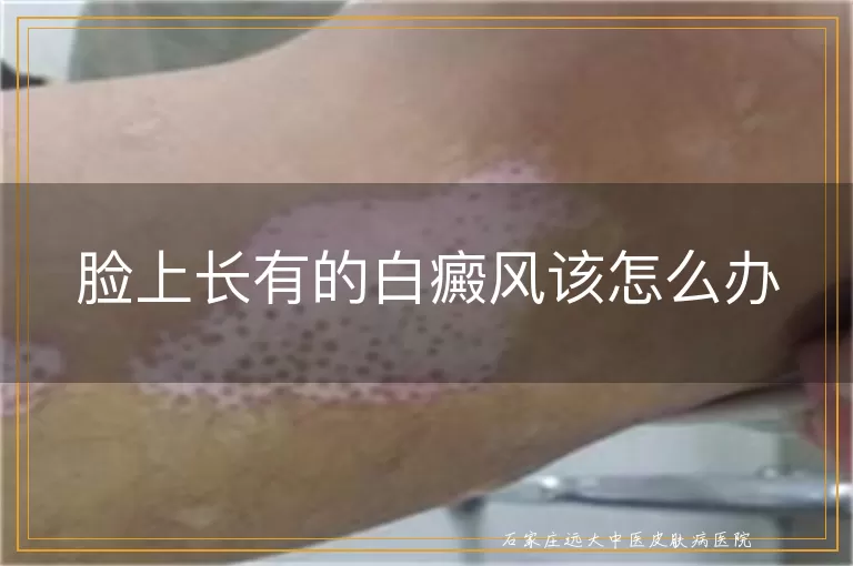 脸上长有的白癜风该怎么办