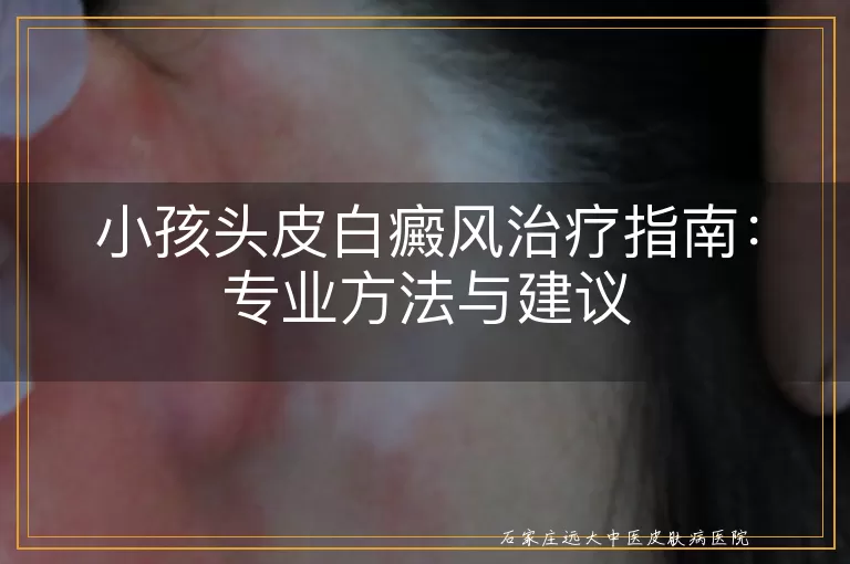 小孩头皮白癜风治疗指南：专业方法与建议