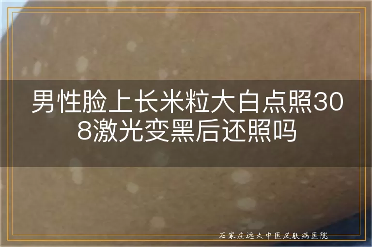 男性脸上长米粒大白点照308激光变黑后还照吗