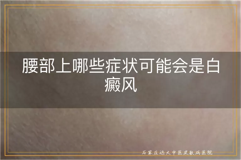 腰部上哪些症状可能会是白癜风