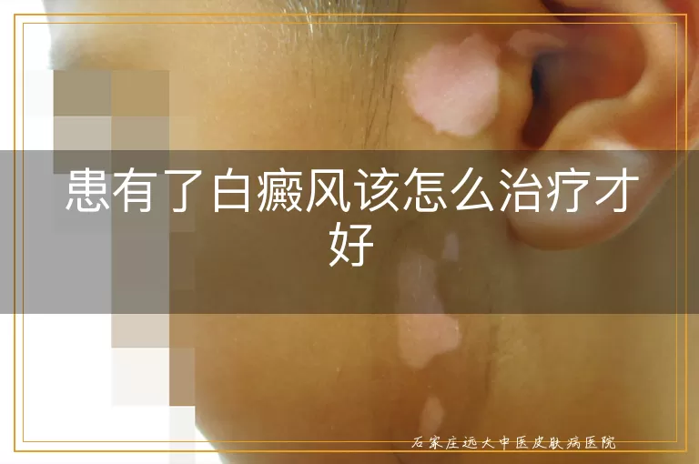 患有了白癜风该怎么治疗才好