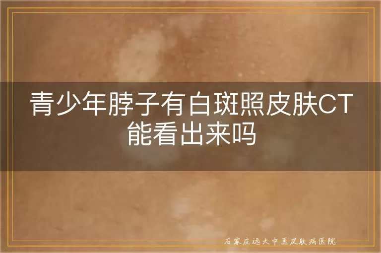 青少年脖子有白斑照皮肤CT能看出来吗