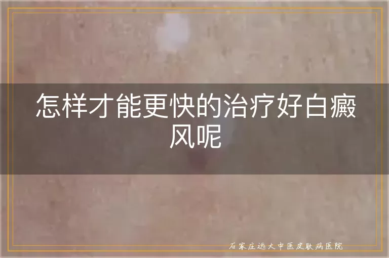 怎样才能更快的治疗好白癜风呢