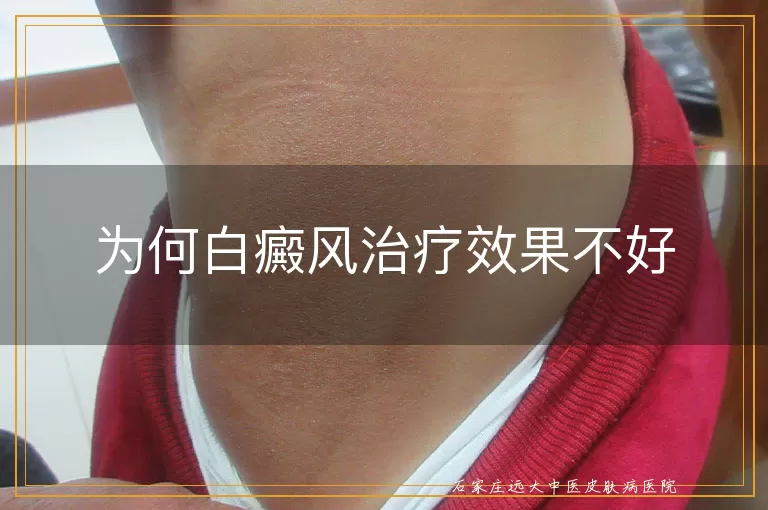 为何白癜风治疗效果不好