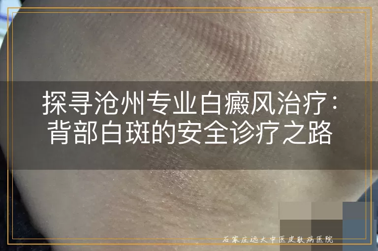 探寻沧州专业白癜风治疗：背部白斑的安全诊疗之路