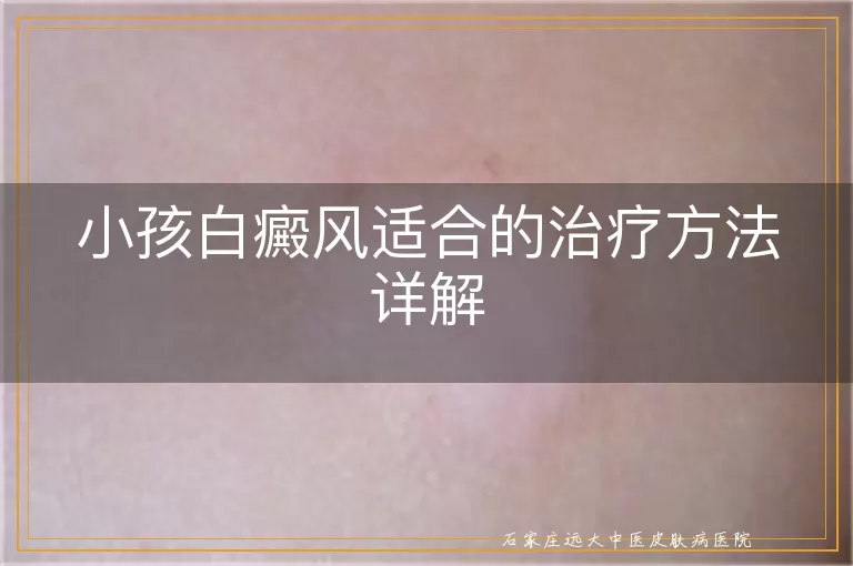 小孩白癜风适合的治疗方法详解