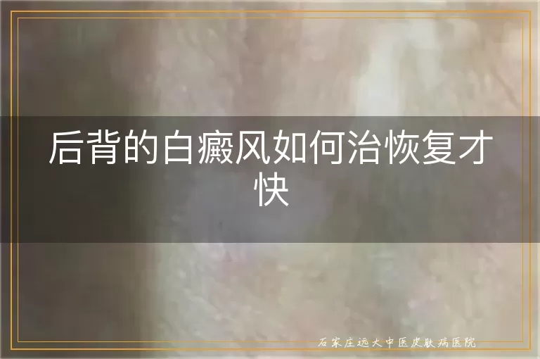 后背的白癜风如何治恢复才快