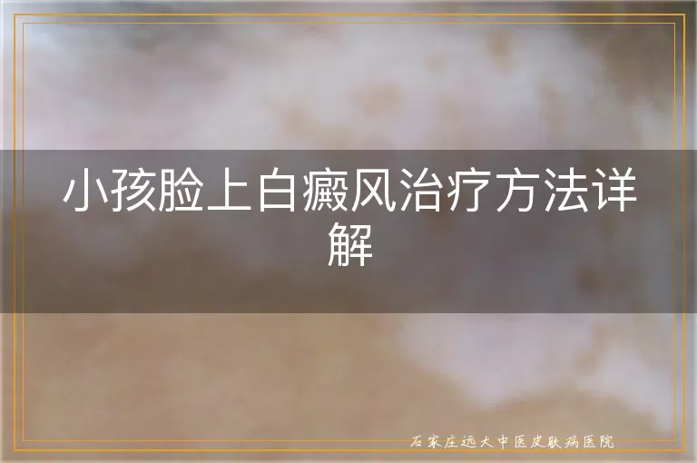 小孩脸上白癜风治疗方法详解
