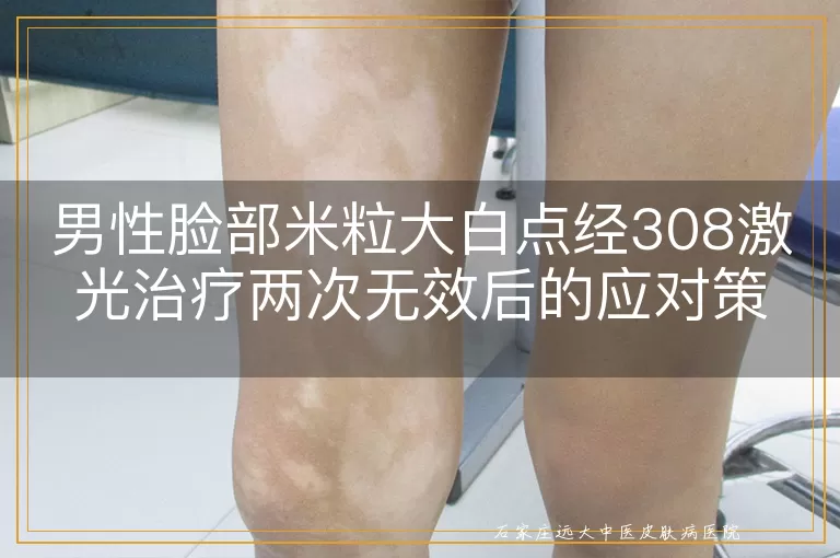 男性脸部米粒大白点经308激光治疗两次无效后的应对策略