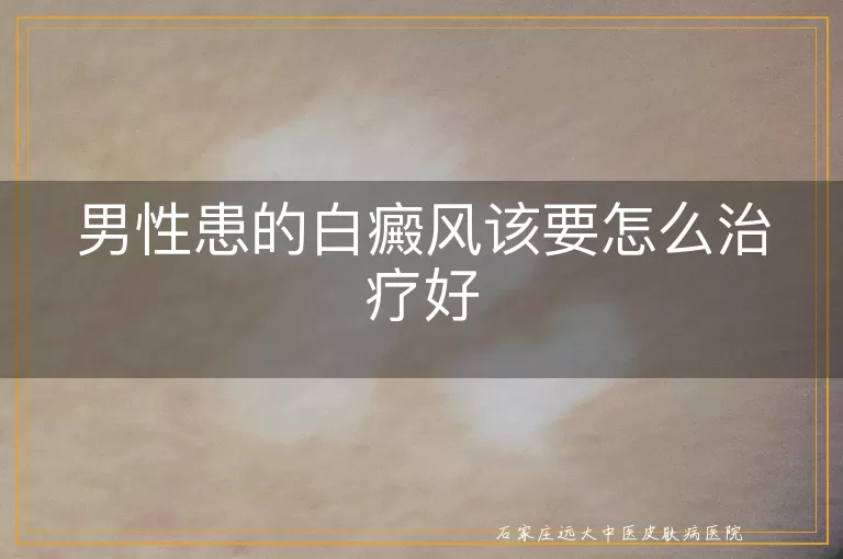 男性患的白癜风该要怎么治疗好