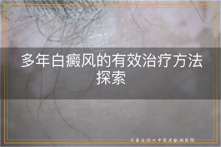 多年白癜风的有效治疗方法探索