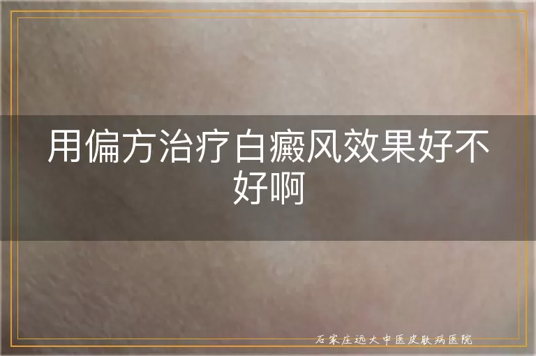 用偏方治疗白癜风效果好不好啊
