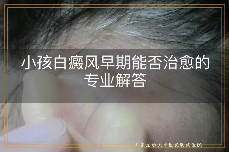小孩白癜风早期能否治愈的专业解答