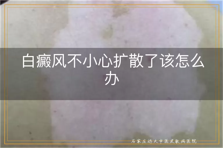 白癜风不小心扩散了该怎么办