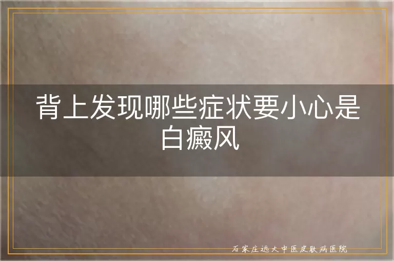 背上发现哪些症状要小心是白癜风
