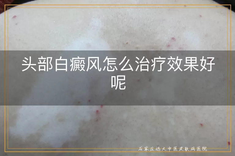 头部白癜风怎么治疗效果好呢
