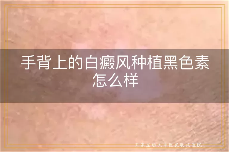 手背上的白癜风种植黑色素怎么样