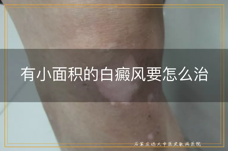有小面积的白癜风要怎么治